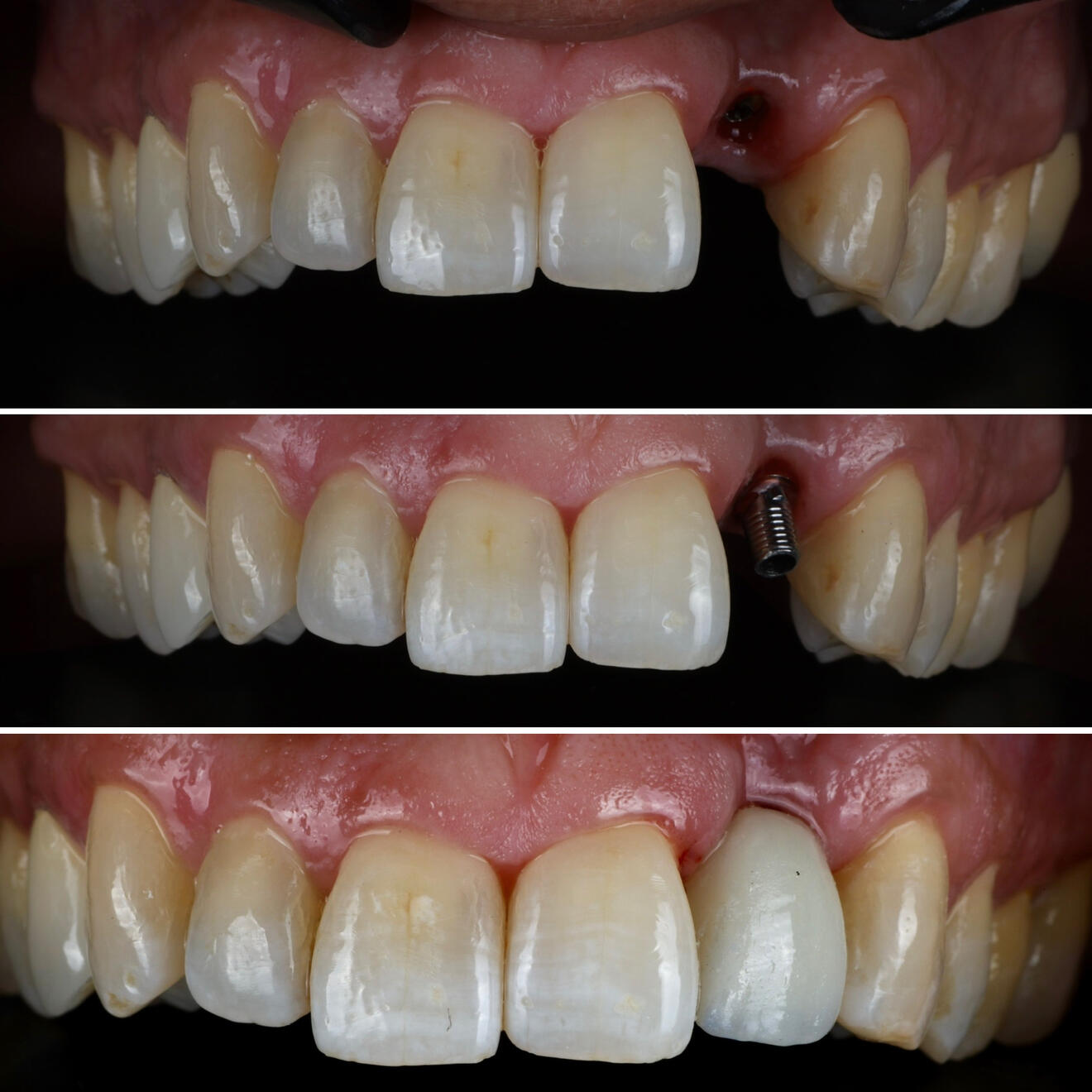 Teeth implant