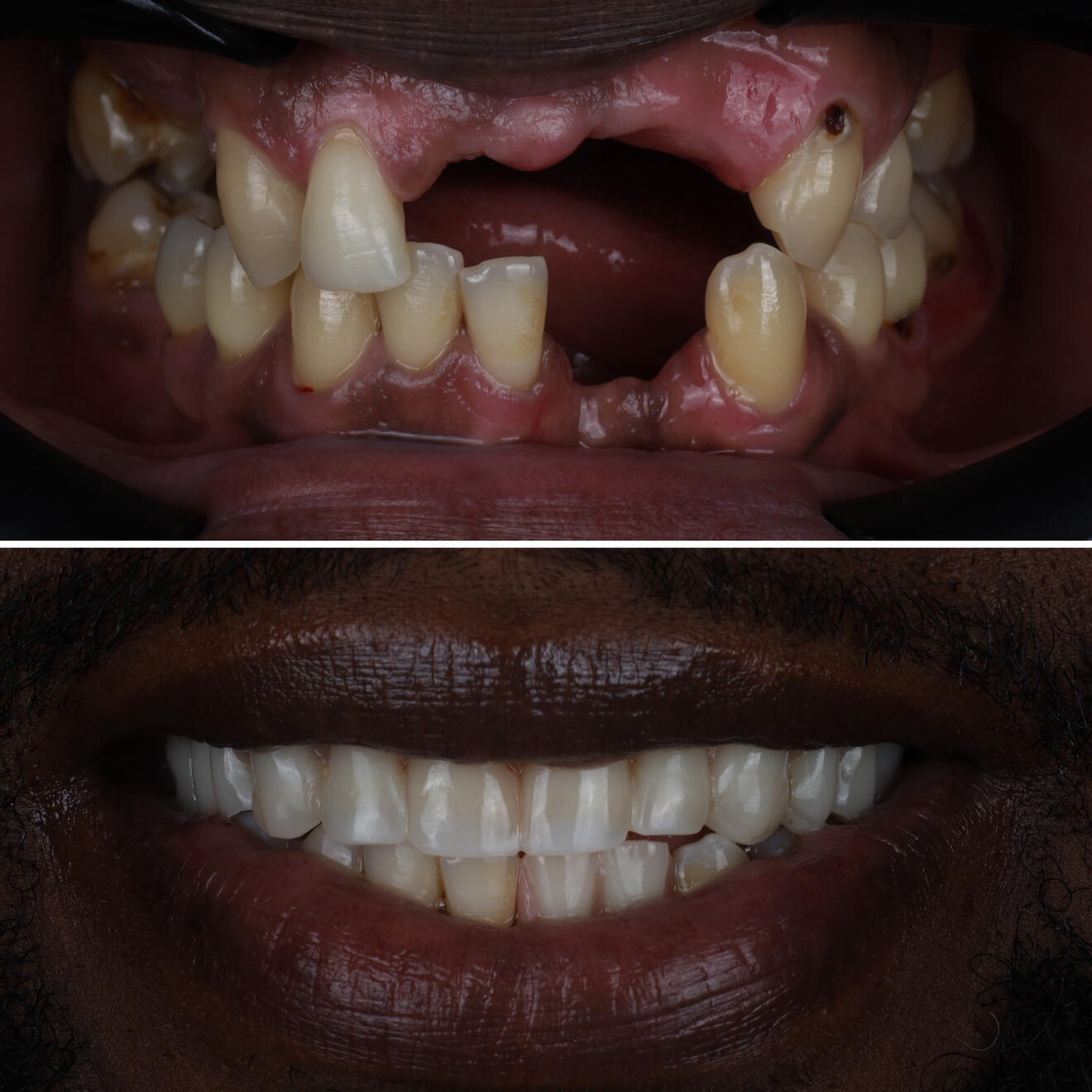 Full arch before and after