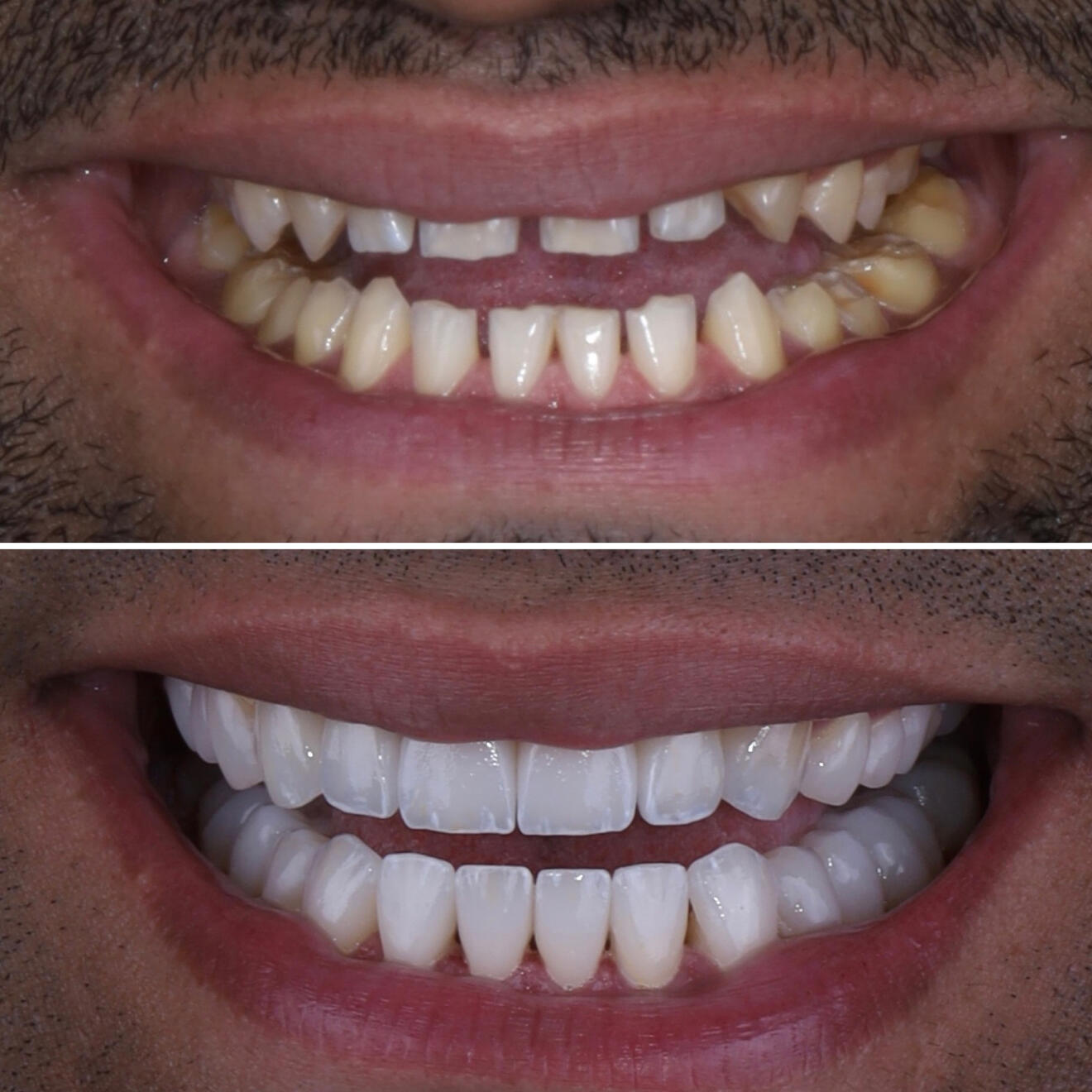 Smile design